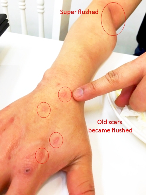 Pear Orange: an interesting effect on scars